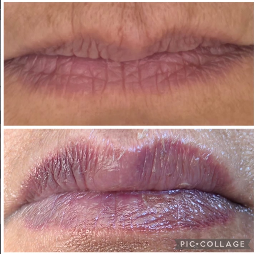 Lips before treatment (top) and after lip filler treatment (bottom)